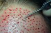 haartransplantation015.jpg
