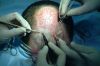 haartransplantation016.jpg